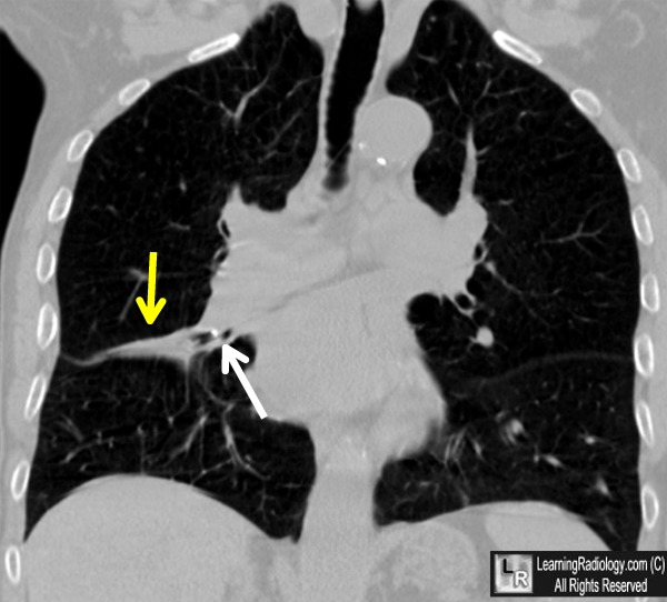 Broncholithiasis